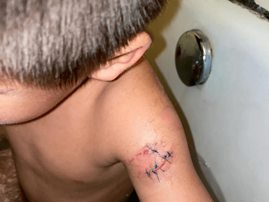 little boy with stitches from an injury at SeaQuest